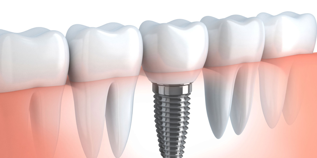 The Comprehensive Guide to Dental Implants: Benefits, Procedure, and Care