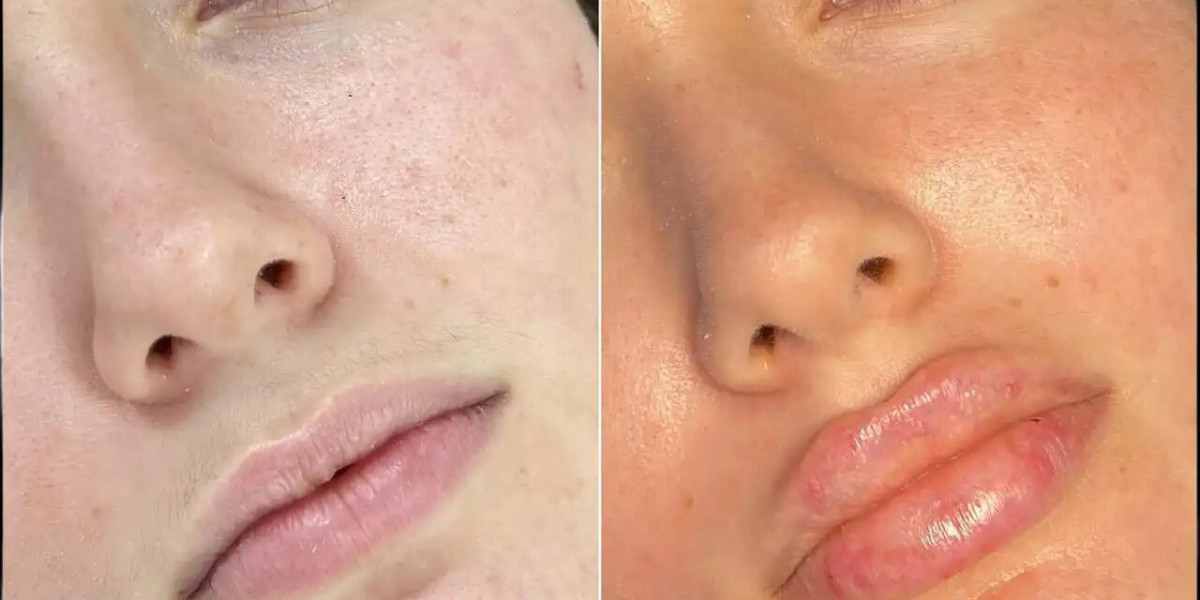 Best Doctors in dubai on Natural vs. Glamorous Fillers Styles