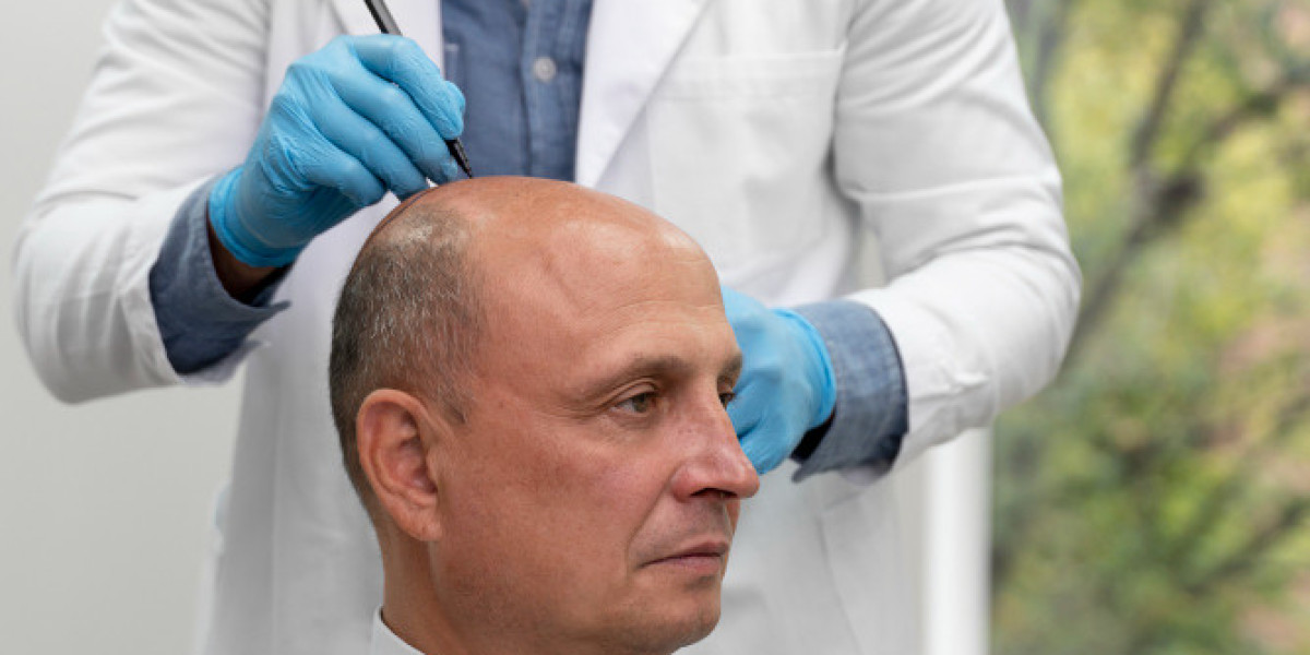 Understanding the Role of a Hair Loss Specialist in San Ramon