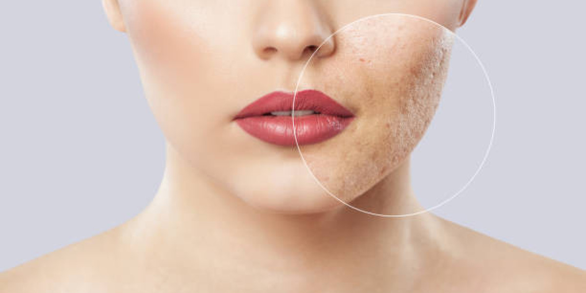 Laser Acne Treatment for Back and Body Acne