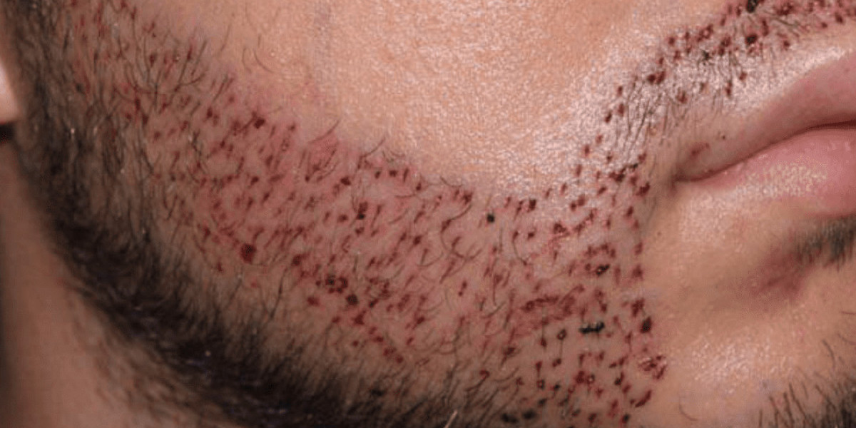 Can a Mustache Hair Transplant Correct Uneven Hair Growth?