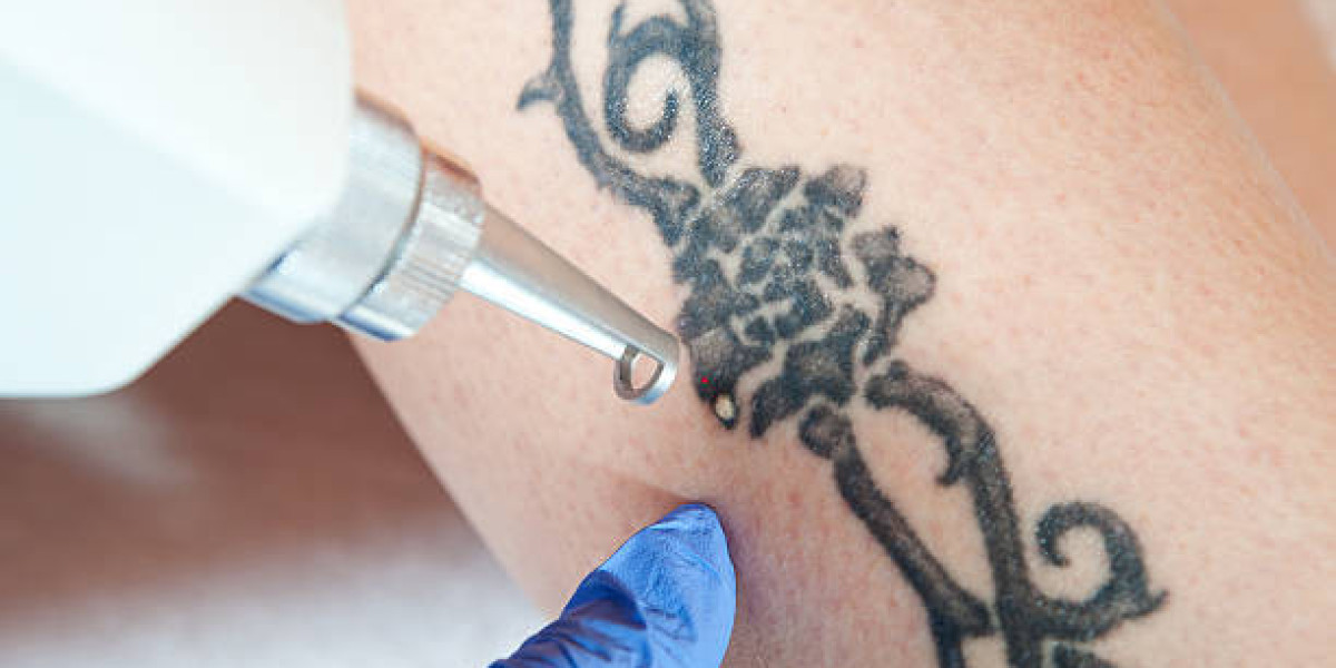 Is Laser Tattoo Removal Painful and How to Manage It?