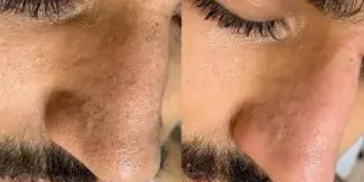 Should Men Combine HydraFacial With Other Treatments in Dubai?