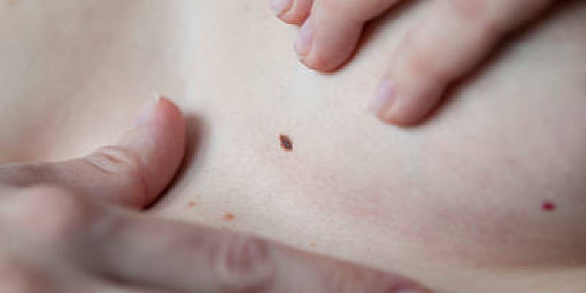 Skin Tag Removal for Sensitive Skin: Gentle Solutions