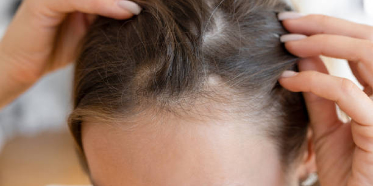 Long-Term Maintenance After Hair Transplant