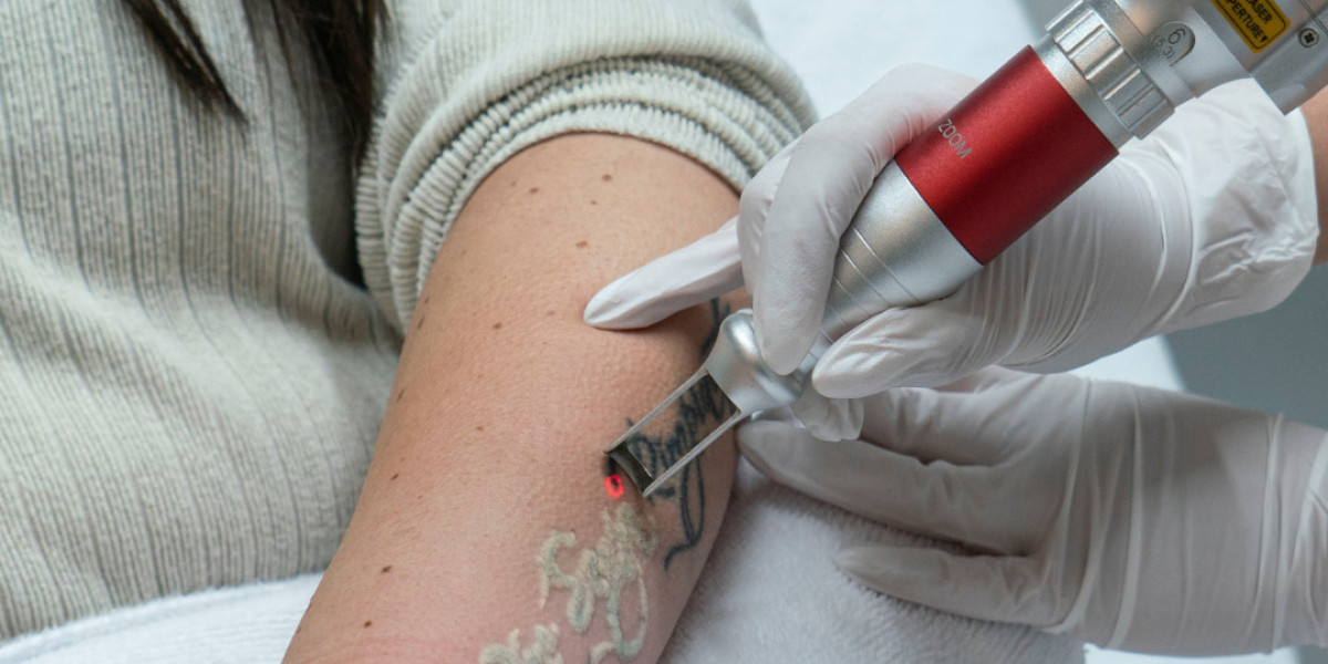 How Many Sessions Does Laser Tattoo Removal Take?