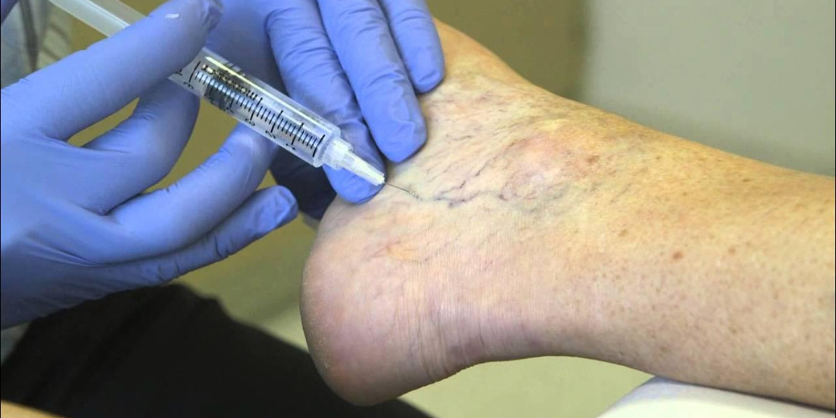 What’s the Difference Between Varicose and Spider Vein Treatment?
