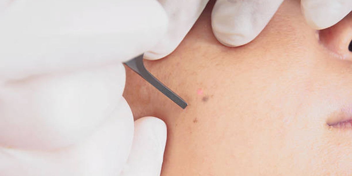 Wart Removal for Face: Gentle Treatment Options