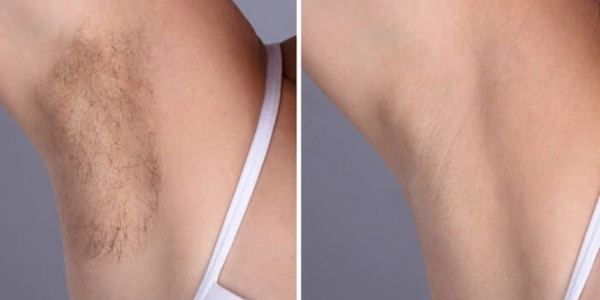 Best Aesthetic Clinic in Dubai for Sensitive Skin Laser Hair Removal