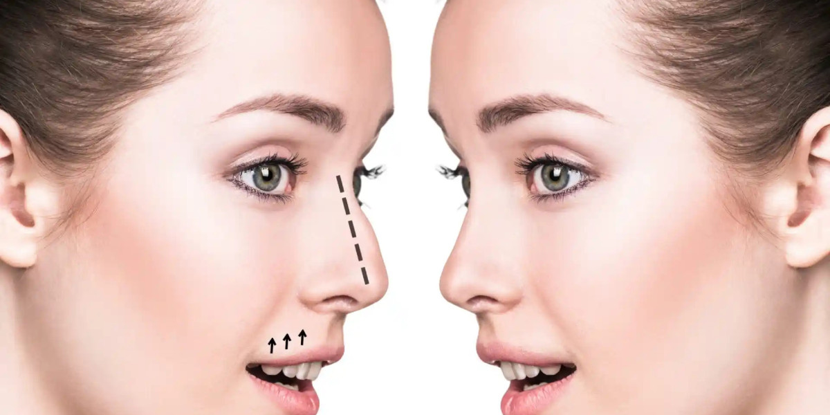 Nose Surgery in Dubai: Safety, Accuracy, and Outcomes