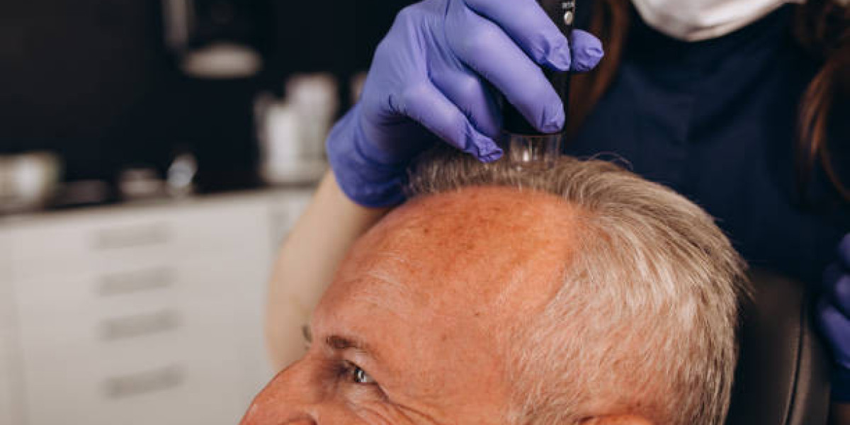 Longevity Benefits Beyond Hair Transplant Cost