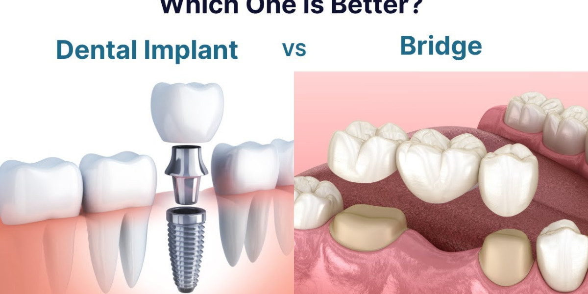 Dental Implants vs. Bridges: What’s Best for You in Dallas?