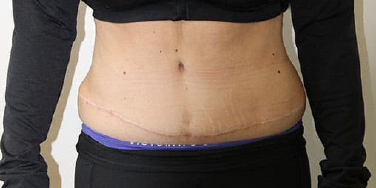 Mini Abdominoplasty: The Low-Downtime Tummy Transformation