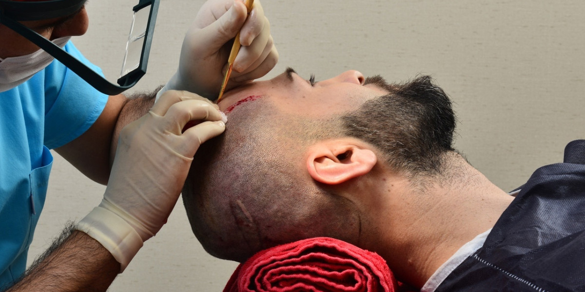 Hair Transplant Innovations That Deliver Incredible Results