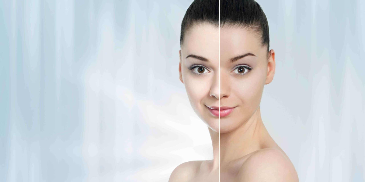Skin Whitening Treatment Dubai: Affordable Options