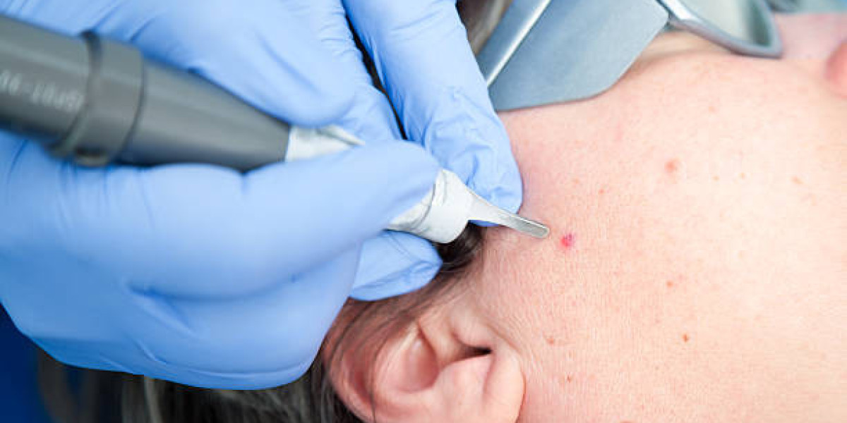 أفضل طرق إزالة الشامة: الليزر أم الجراحة أم الكريمات؟