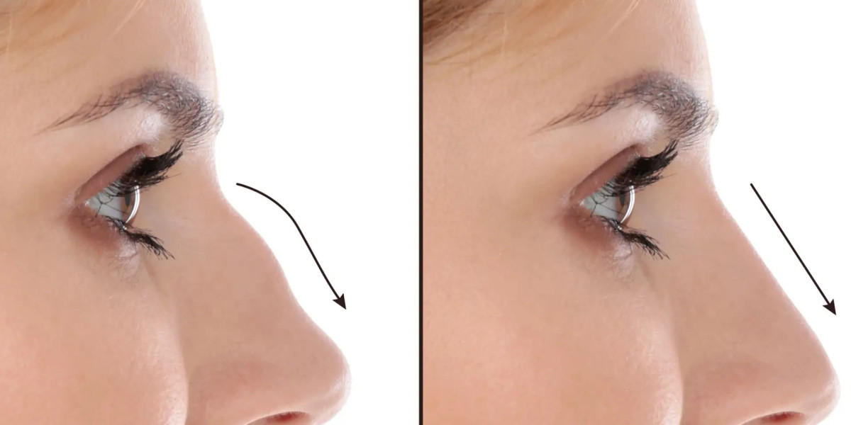 Nose Deviated Septum Surgery in Dubai: A Clinical Path to Better Breathing