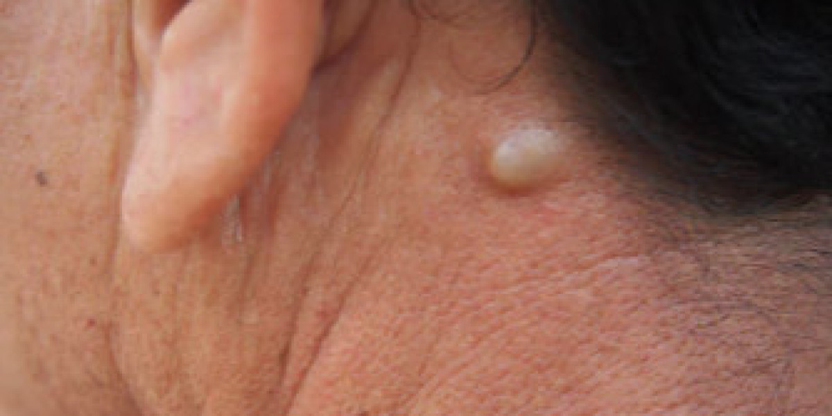How to Prevent Sebaceous Cysts From Returning