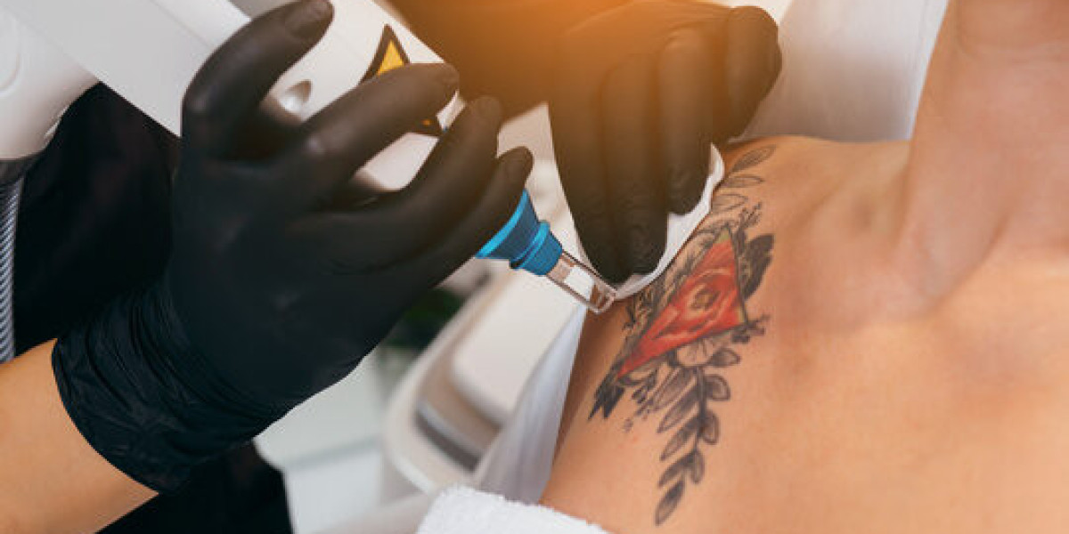 Laser Tattoo Removal That Leaves Only Smooth Skin