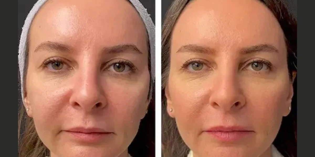 Best Aesthetic Clinic in Dubai for Mesotherapy Personalized Care