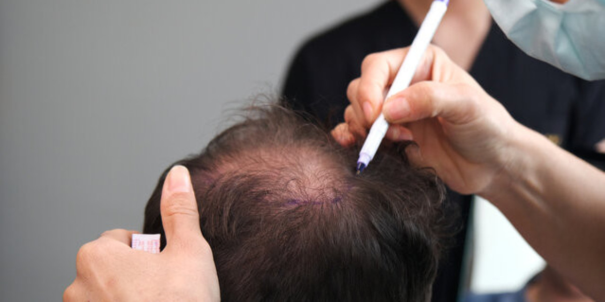 Female Hair Loss? Here’s How Hair Transplants Can Help