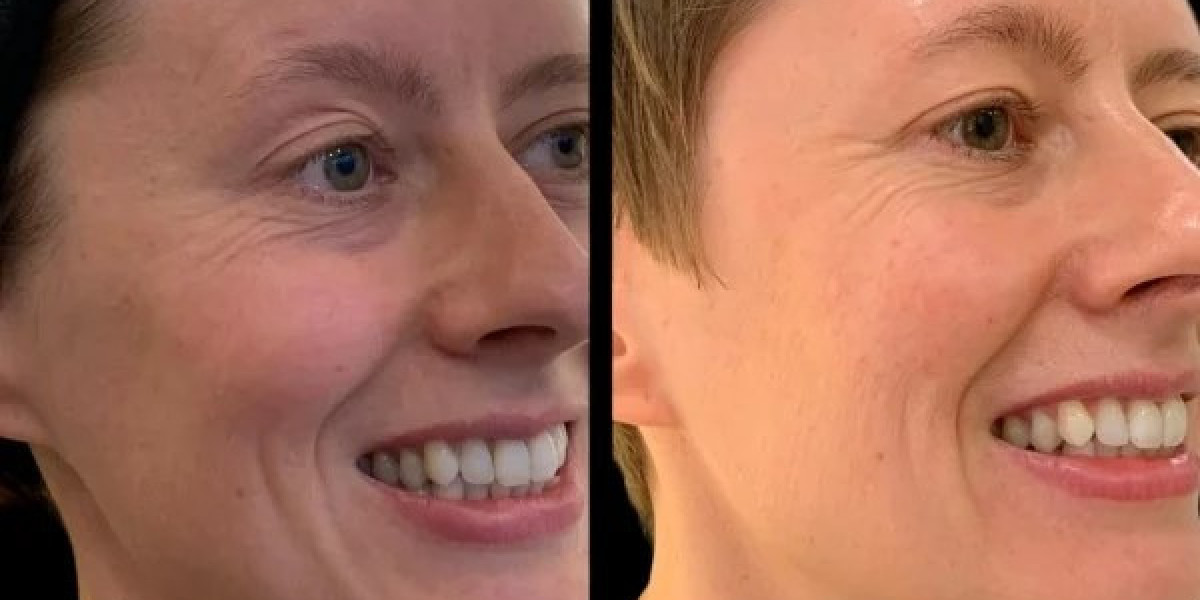 Lift Your Glow with Profhilo at the Best Aesthetic Clinic in dubai