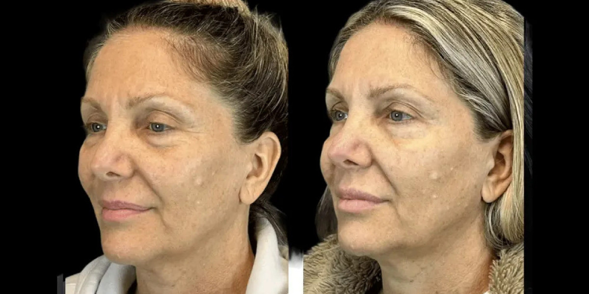 Botox Treatments in Dubai for Facial Contouring and Jawline Slimming