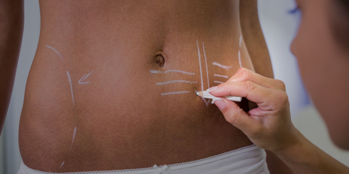 Does BodyTite Liposuction Tighten Loose Skin?