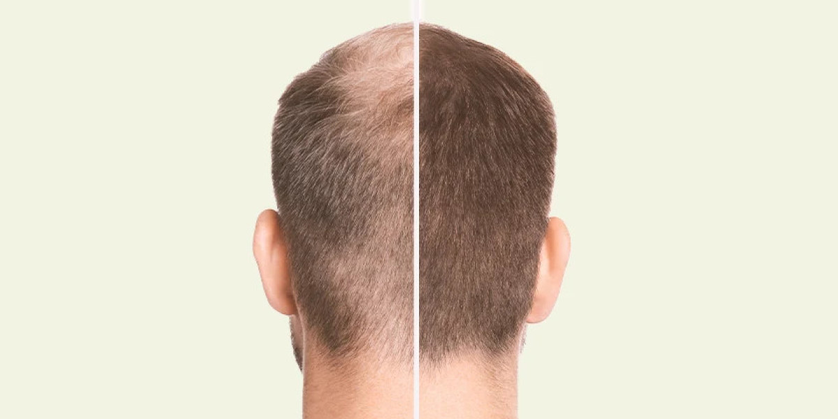 Dubai Crown Hair Transplant: Aftercare Guide