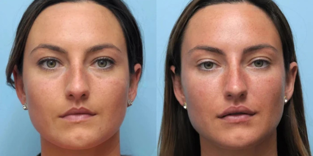 Best Plastic Surgeon in Dubai for Thread Lift Focused on Facial Harmony