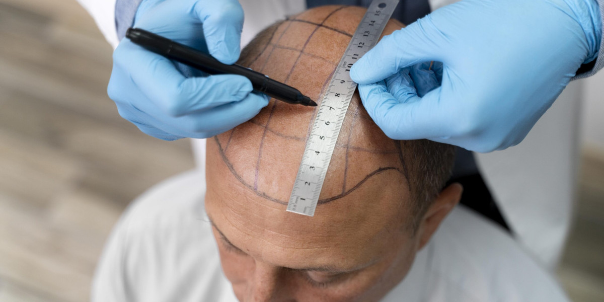Hair Transplant Techniques Explained: FUT vs FUE