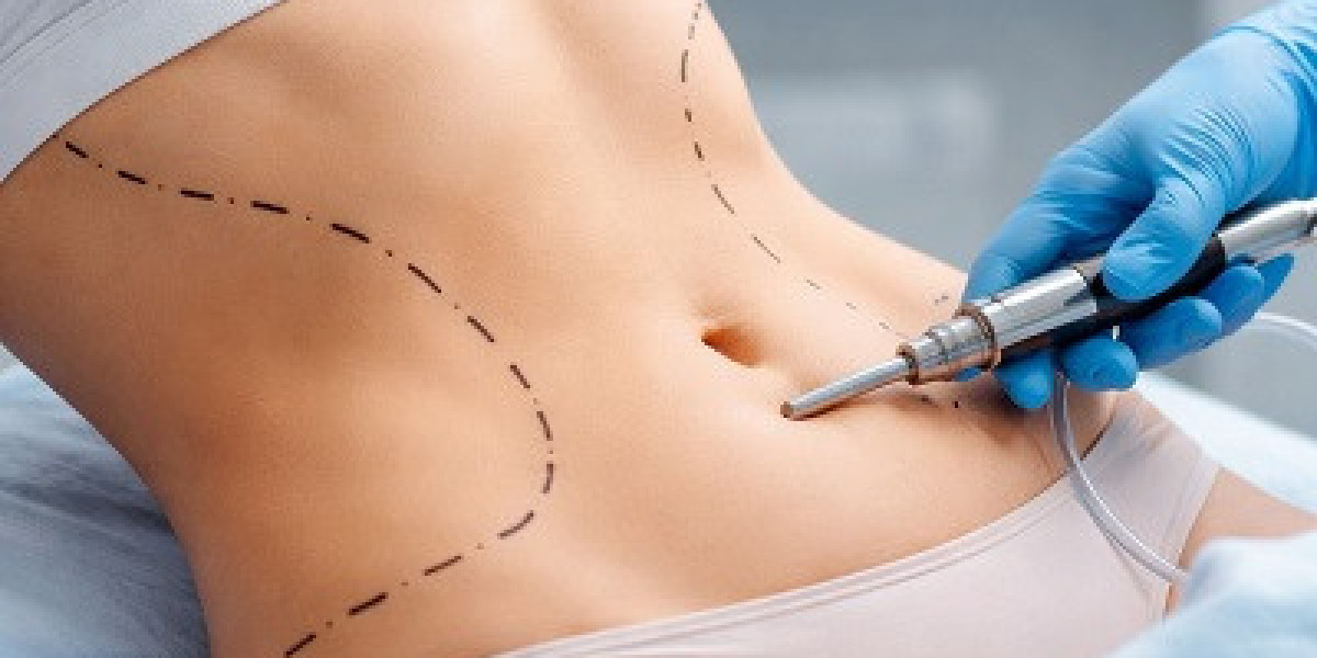 Liposuction and Body Contouring: What You Should Know