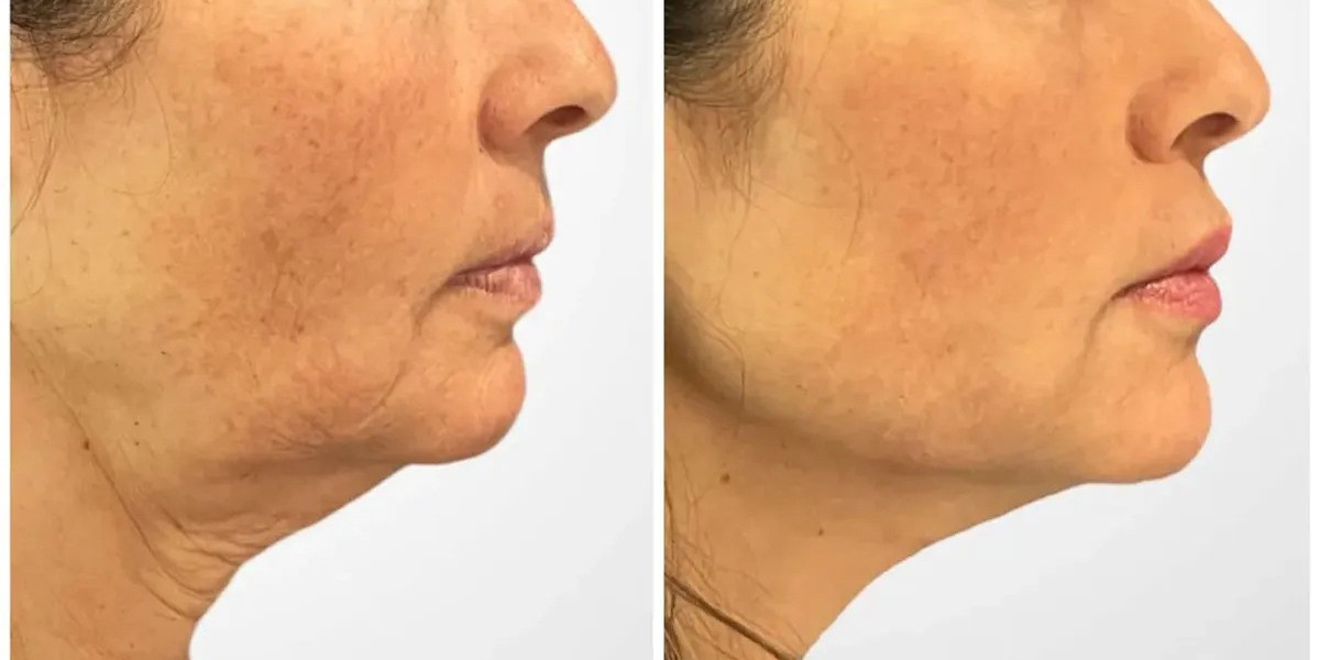 Best Doctors in Dubai: Thread Lift Non-Surgical Anti-Aging Solutions