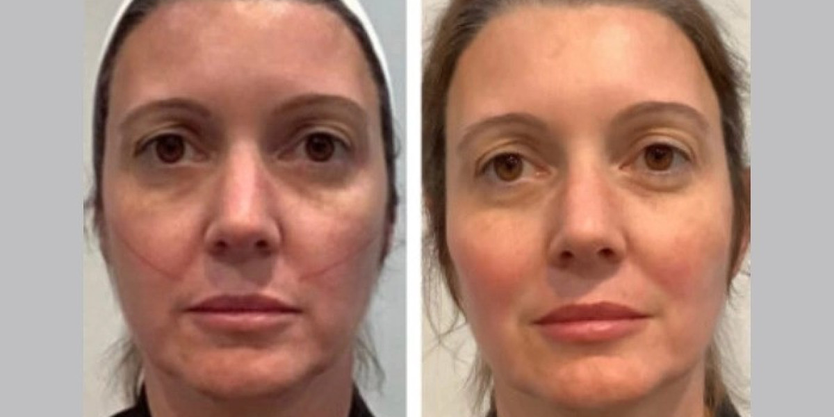 Thread Lift in Dubai Creates Smooth Lifted Skin With Minimal Recovery Time