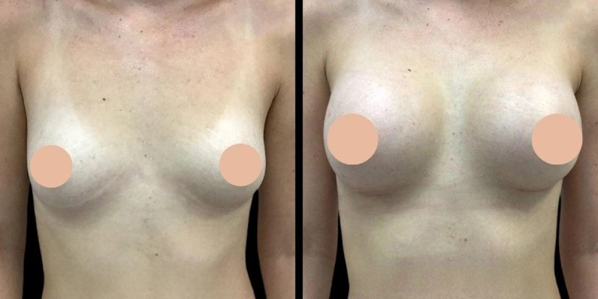 Breast Augmentation Surgery in Dubai: How Lifestyle Affects Results