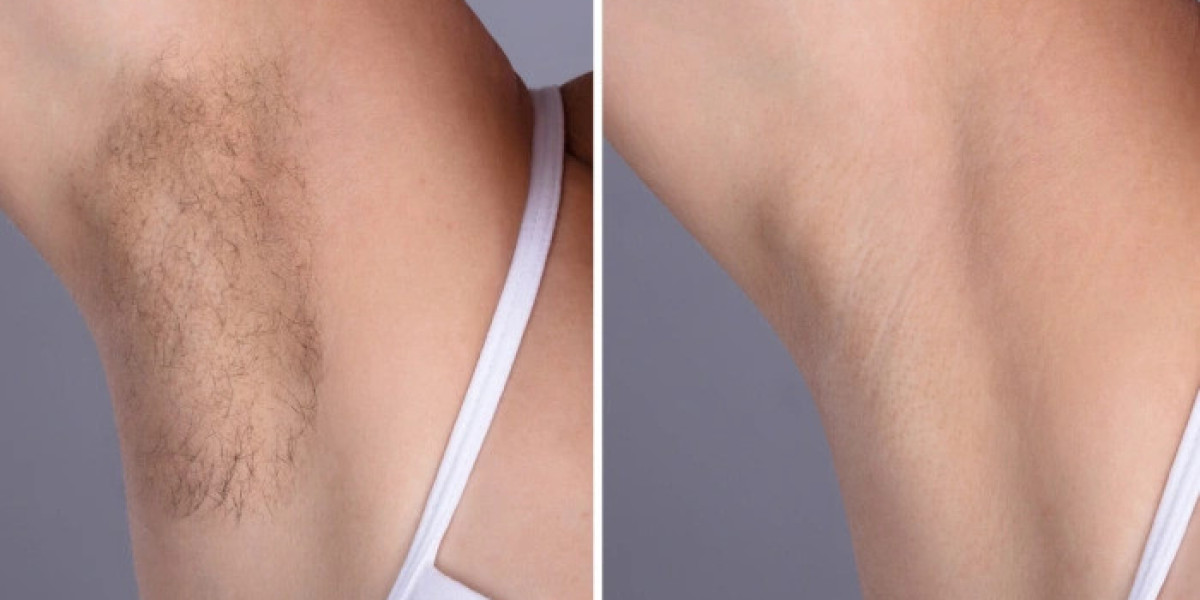 Best Doctors in Dubai Laser Hair Removal at Top Aesthetic Clinics